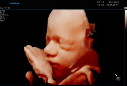 USG 3D dziecka w poradni ginekologicznej w Zambrowie