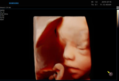 USG ciąży w poradni ginekologicznej w Zambrowie