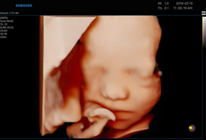 USG 3D płodu w Zambrowie – diagnostyka prenatalna