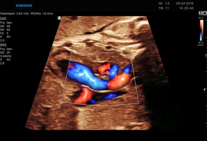 pracownia USG w Zambrowie - ocena przepływów, Doppler