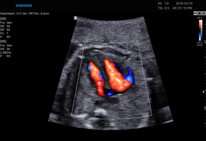 USG w Zambrowie – diagnostyka prenatalna