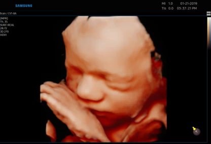 USG 3D dziecka  – diagnostyka prenatalna w Zambrowie