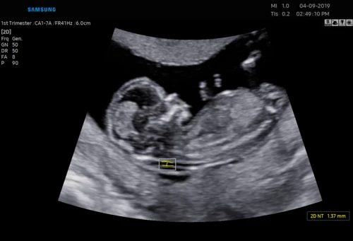 USG 3D dziecka w poradni ginekologicznej w Zambrowie –ocena NT, PAPP -A